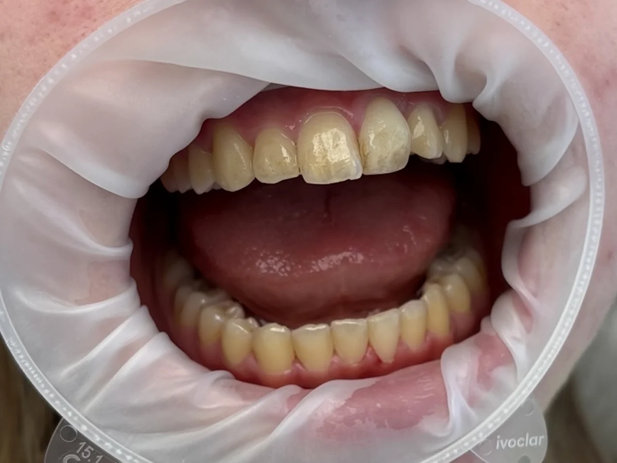 Druhý klinický záber chrupu pred dentálnou hygienou
