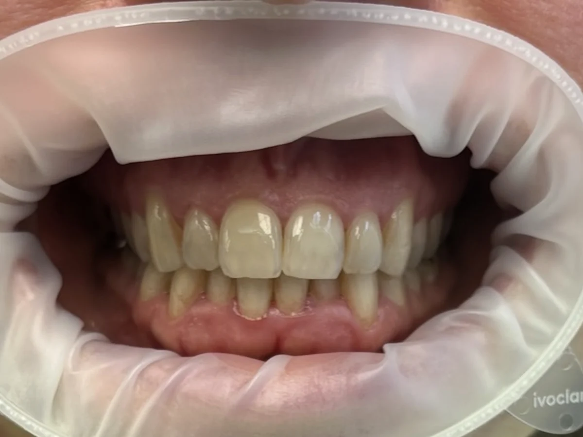 Chrup pacienta pred dentálnou hygienou