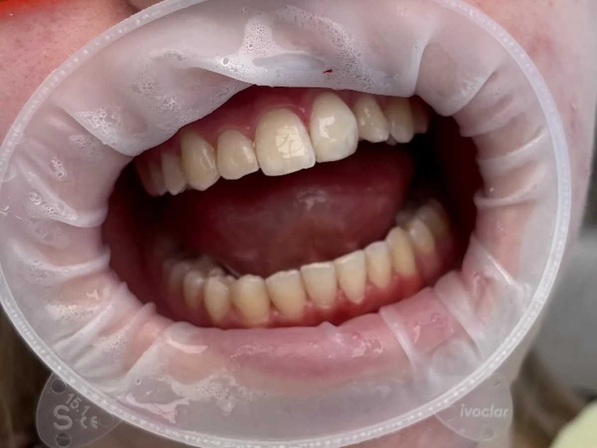 Druhý klinický záber chrupu po dentálnej hygiene