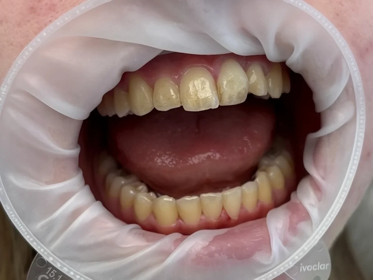 Chrup pred profesionálnou dentálnou hygienou